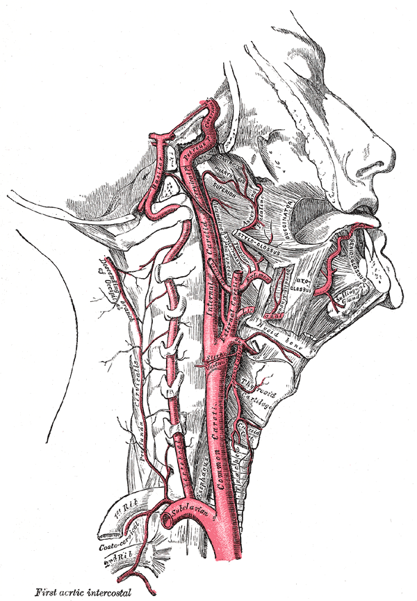 Carotid Stenosis